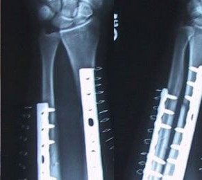 Gebrochene Hand. Ein klarer Unfall © wikipedia