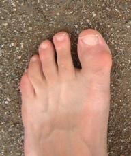 Chronische Fußbeschwerden beim Klettern oder Hallux & Co sind keine Unfälle © Arch. Jentzsch