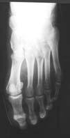 Hallux Valgus