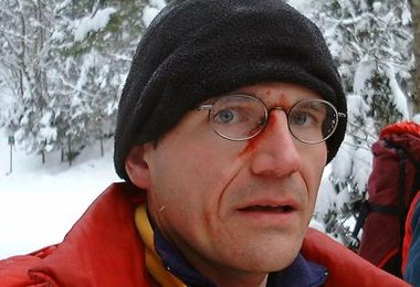 Eine Gesichtsverletzung - diese Verletzungen können besonders beim Mixedklettern auftreten.